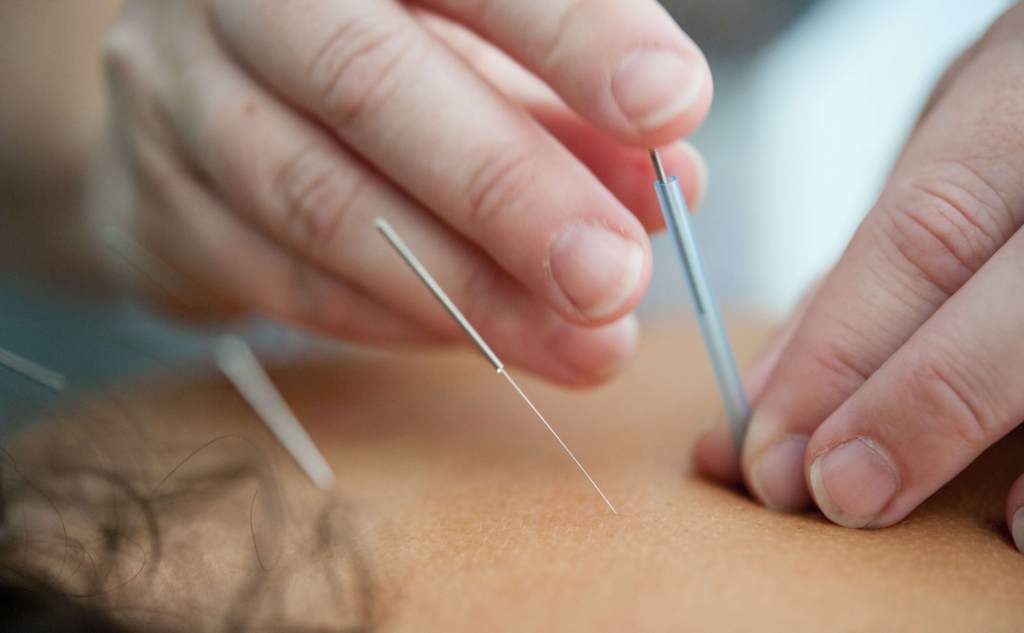 Acupuncture at Willow Park Village Chiropractic & Wellness in Calgary